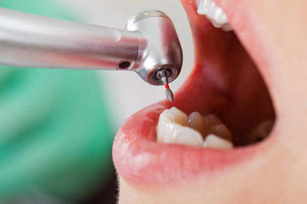 Best Knocked-Out Tooth (Avulsed Tooth) Treatment in Florence, TX